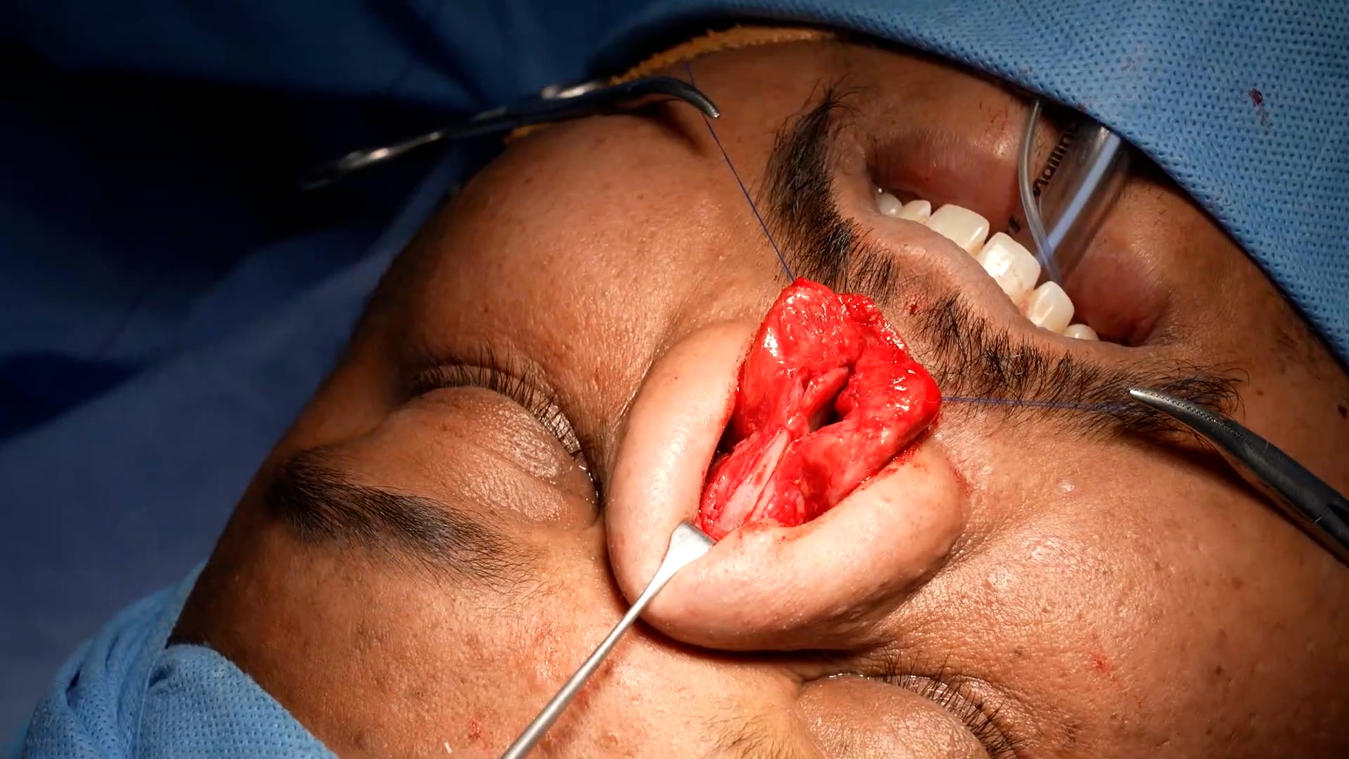 Rhino plasty surgery